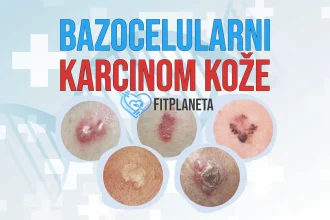 Bazocelularni karcinom kože