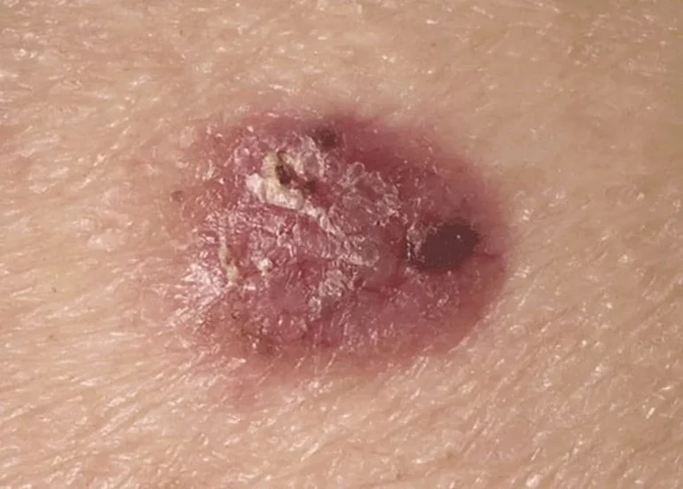Nodularni bazocelularni karcinom kože
