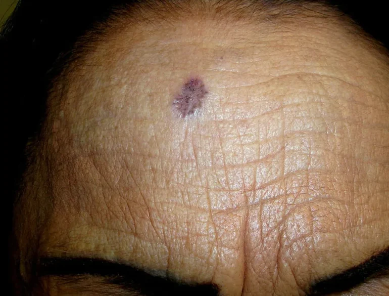 Površinski bazocelularni karcinom kože