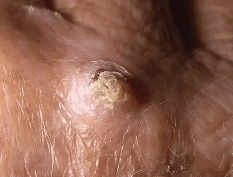 Skvamozni karcinom kože