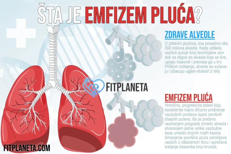 Šta je Emfizem pluća?