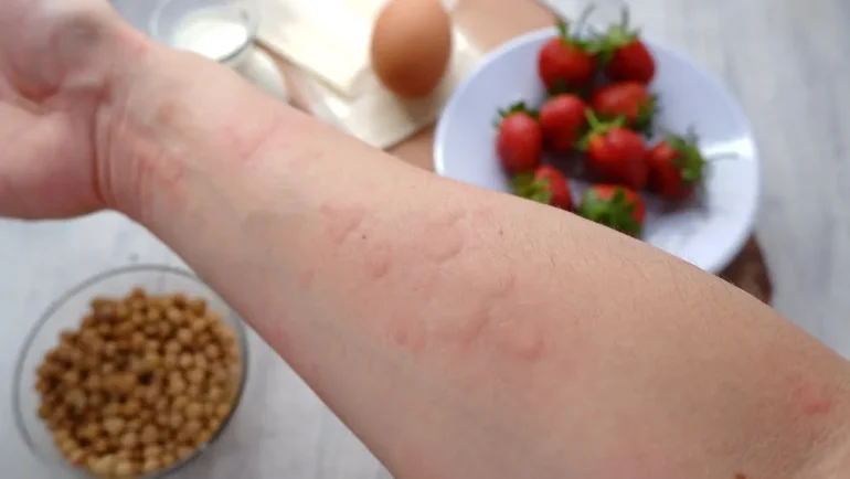 Alergija na hranu