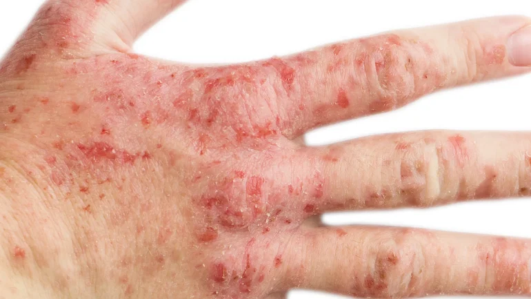 Ekcem Atopijski dermatitis