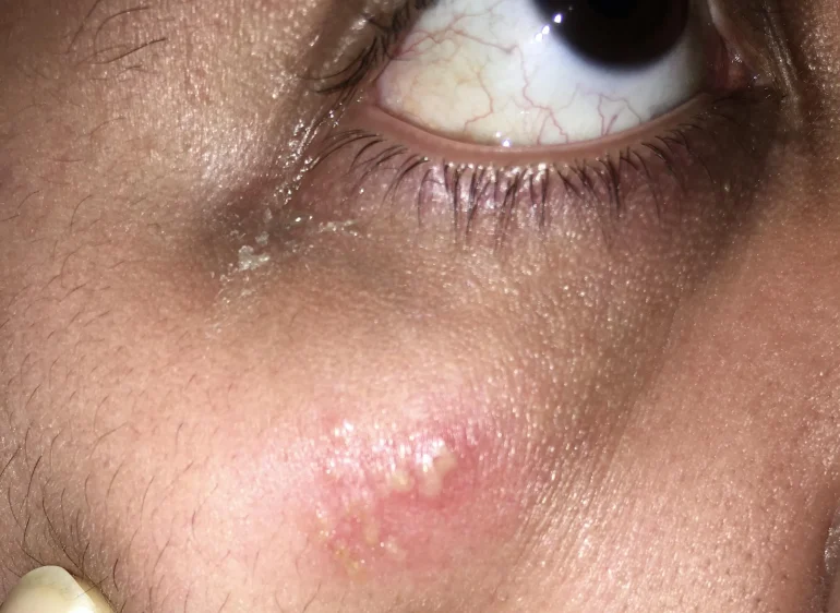 Herpes na oku - kako izgleda herpes na koži slike 1