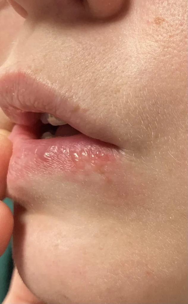Herpes na usni - kako izgleda herpes na koži slike 1