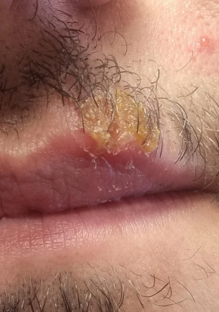 Herpes na usni - kako izgleda herpes na koži slike 2
