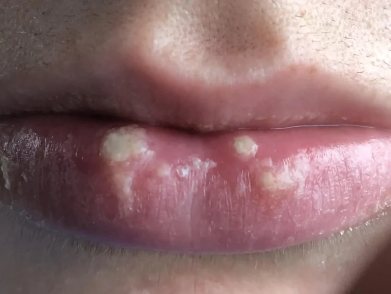 Herpes na usni - kako izgleda herpes na koži slike