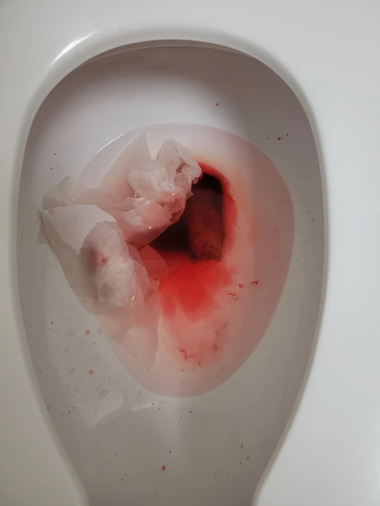 Kako izgleda krv u stolici slike 1
