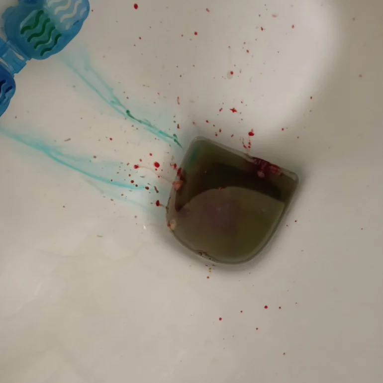 Kako izgleda krv u stolici slike 7