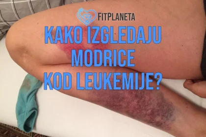 Kako izgledaju modrice kod leukemije