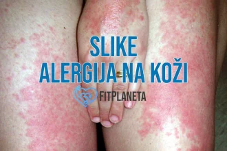 Slike alergija na koži