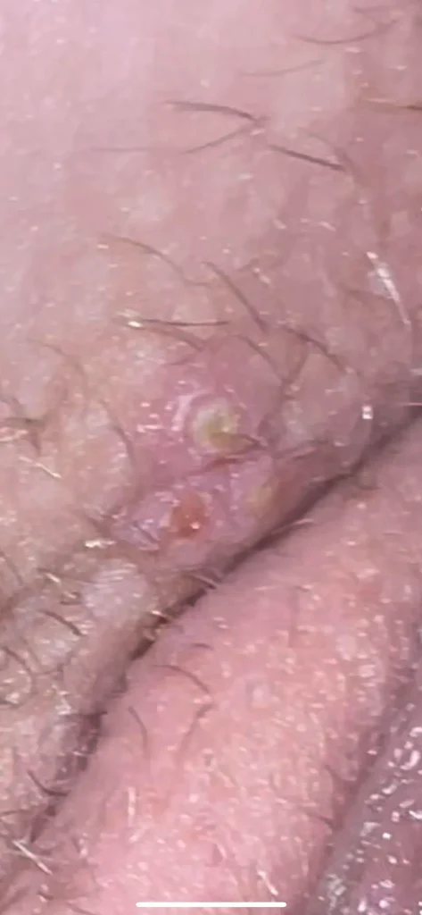 Vaginalni herpes - kako izgleda herpes na koži slike 1