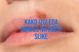 kako izgleda herpes na koži slike
