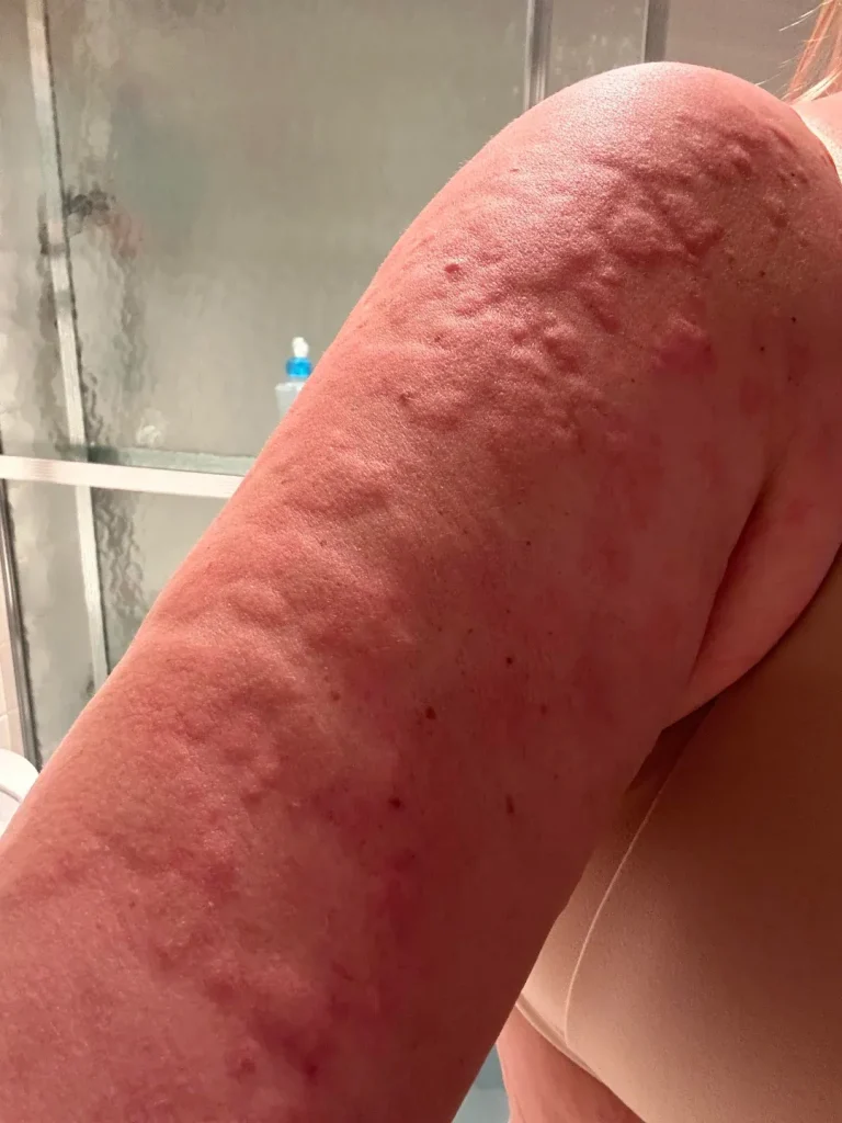 slike alergija na koži 1