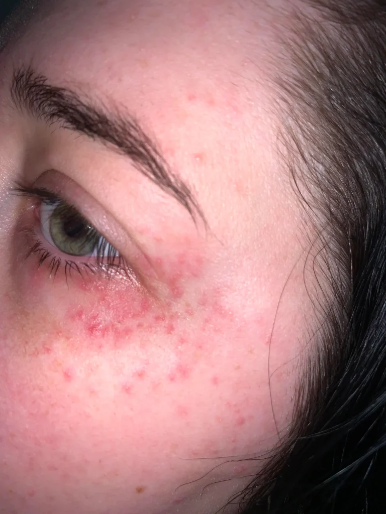 slike alergija na koži 11