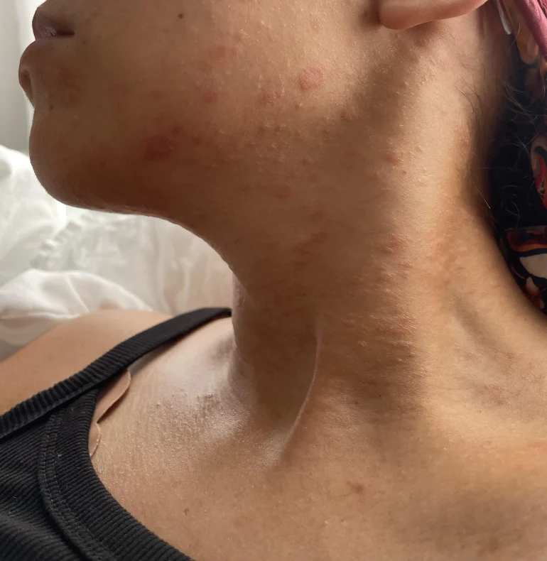 slike alergija na koži 12