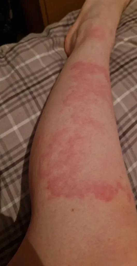 slike alergija na koži 13