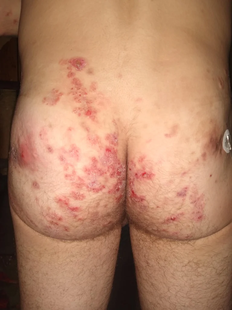 slike alergija na koži 15