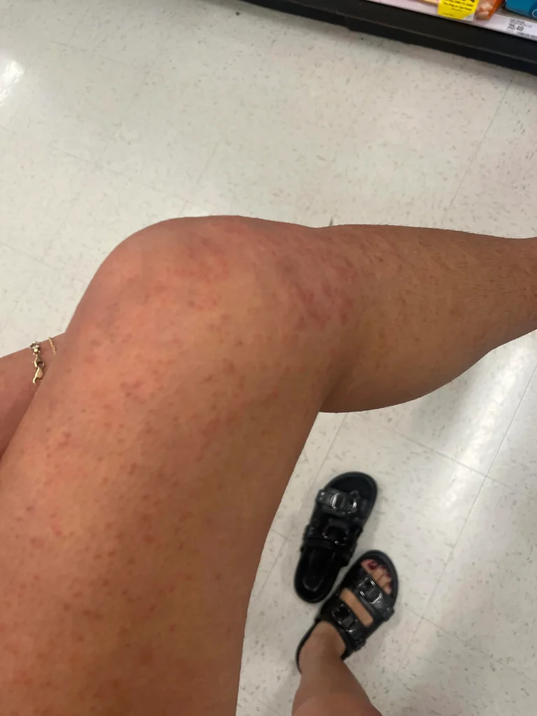 slike alergija na koži 16