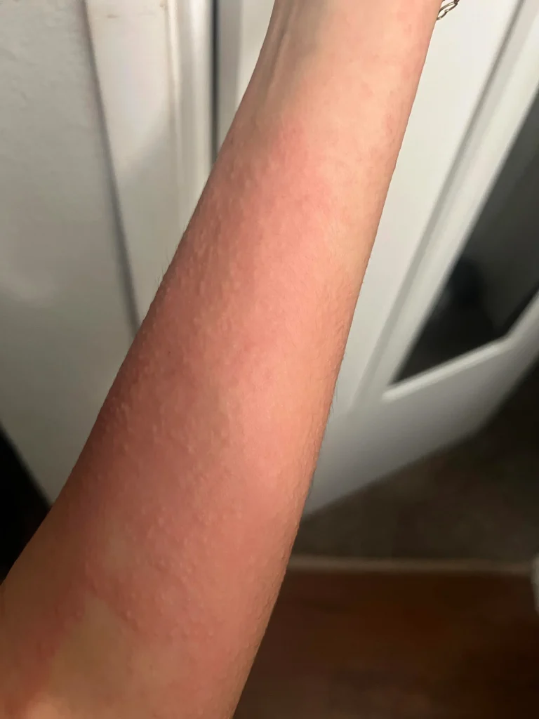 slike alergija na koži 17