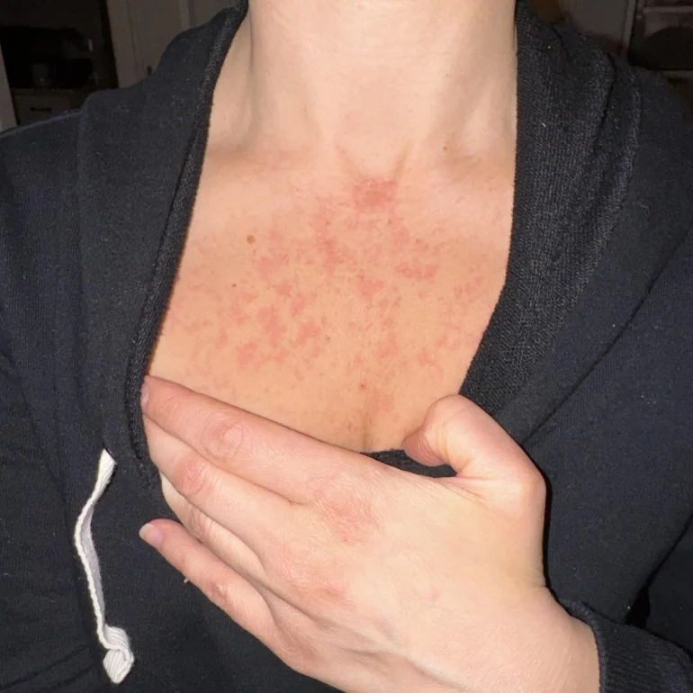 slike alergija na koži 19