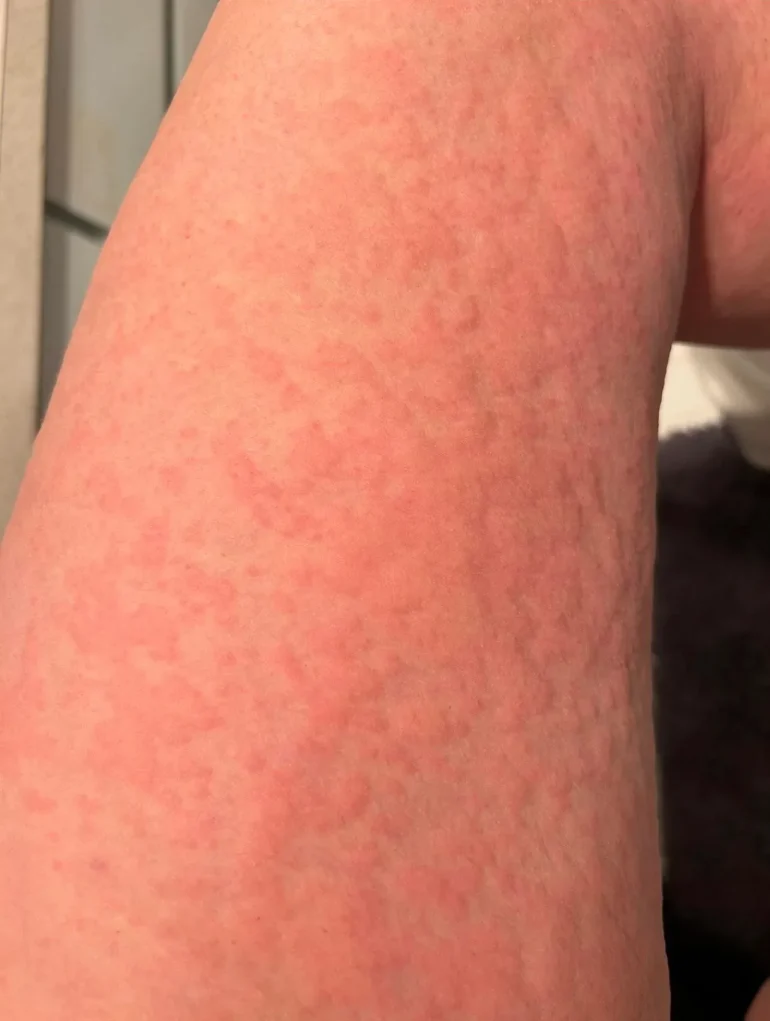 slike alergija na koži 2