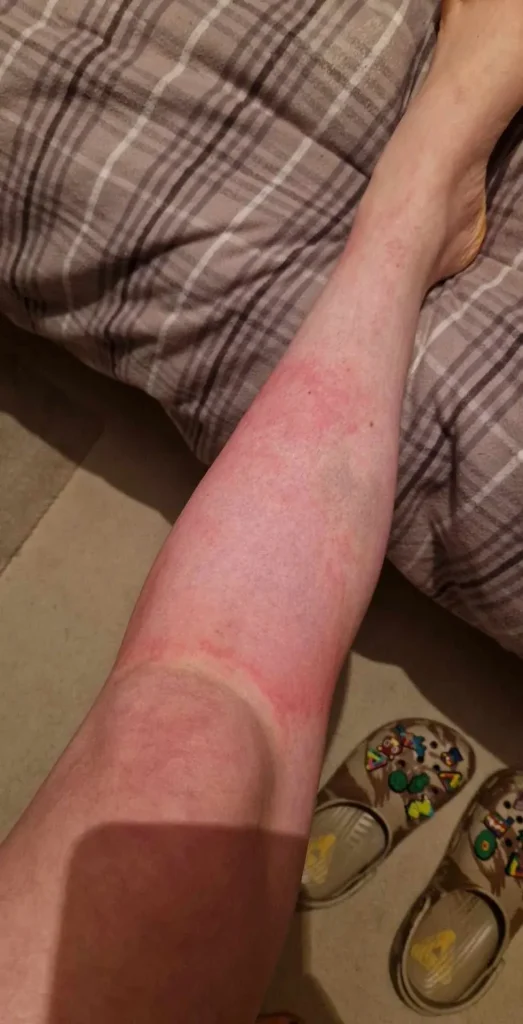 slike alergija na koži 20