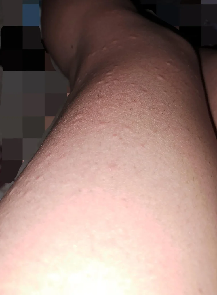 slike alergija na koži 22