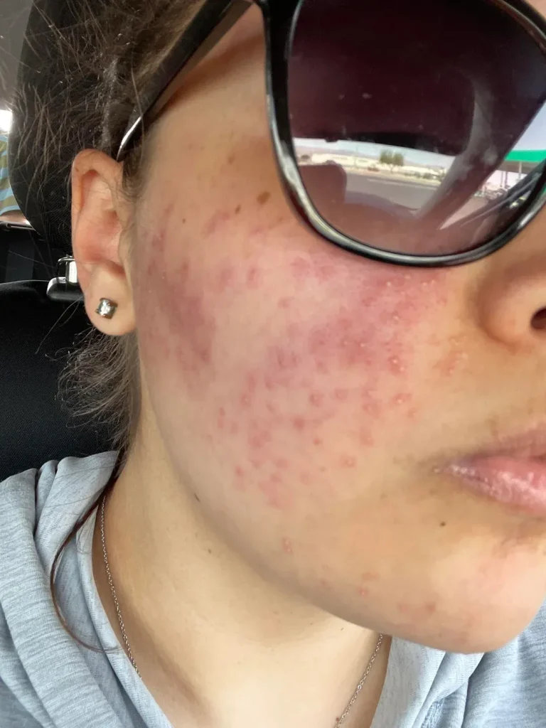 slike alergija na koži 23