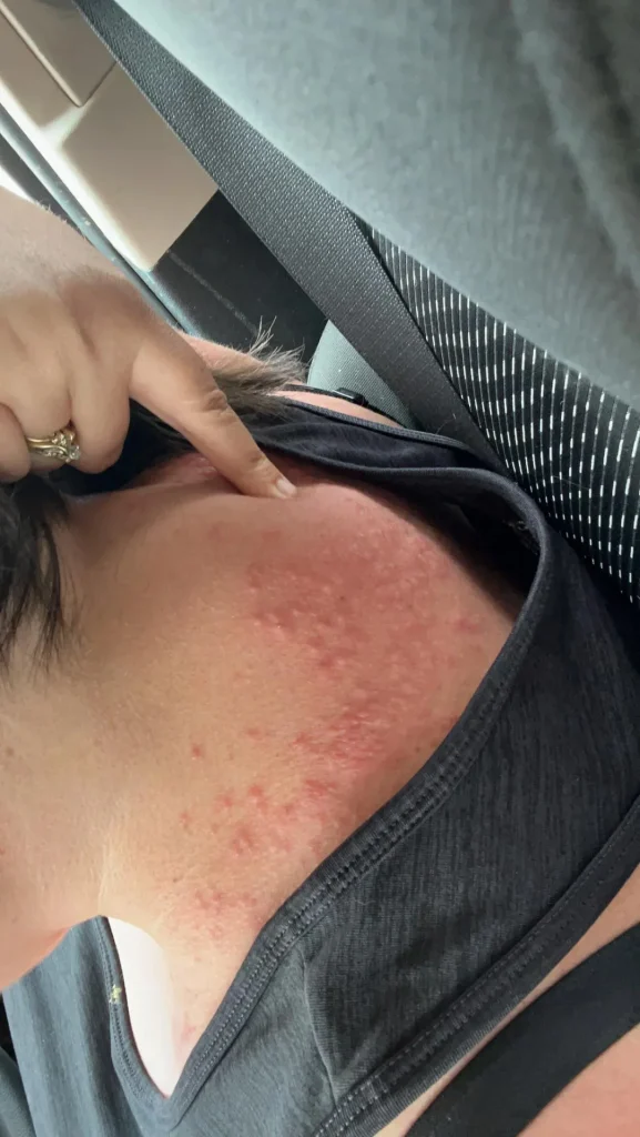 slike alergija na koži 25