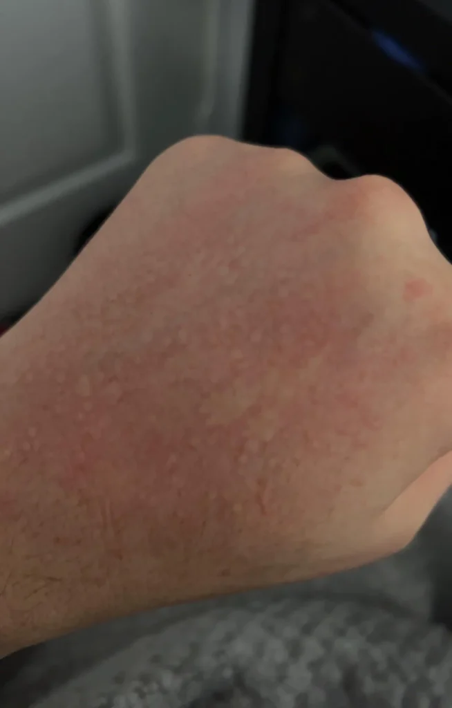 slike alergija na koži 3