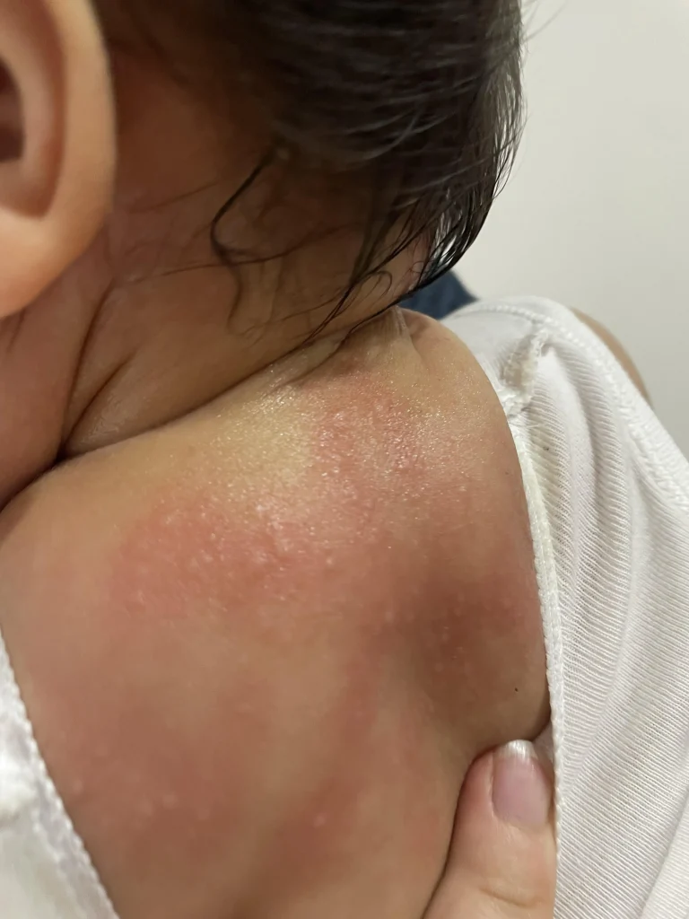 slike alergija na koži 4