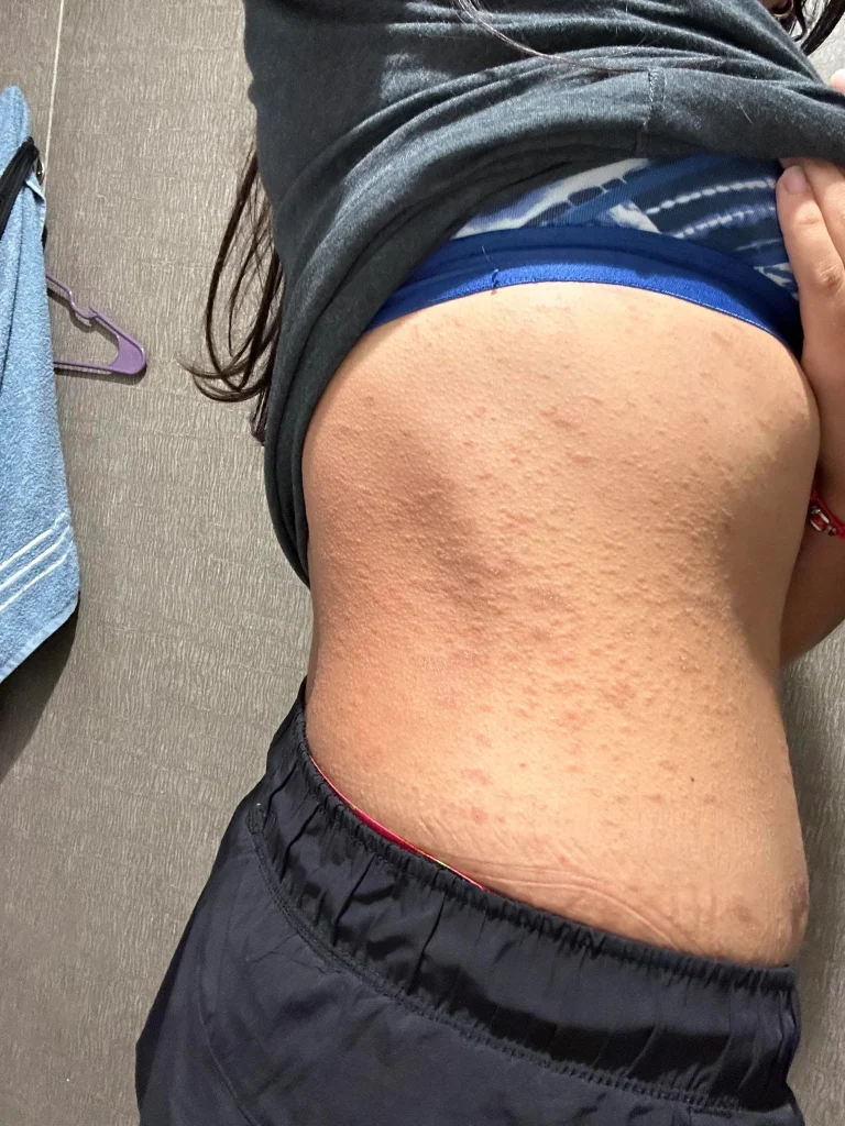 slike alergija na koži 5
