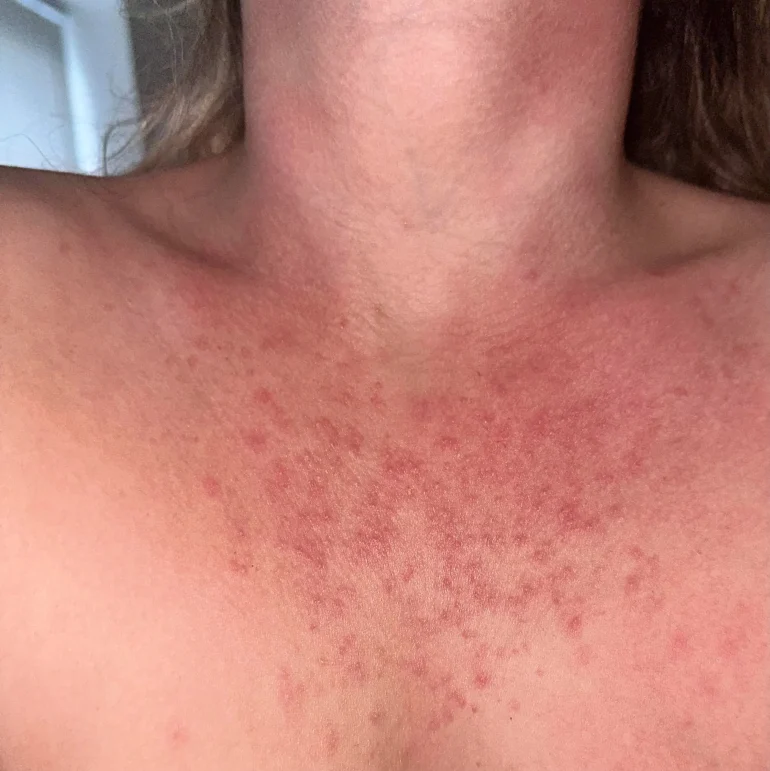 slike alergija na koži 6