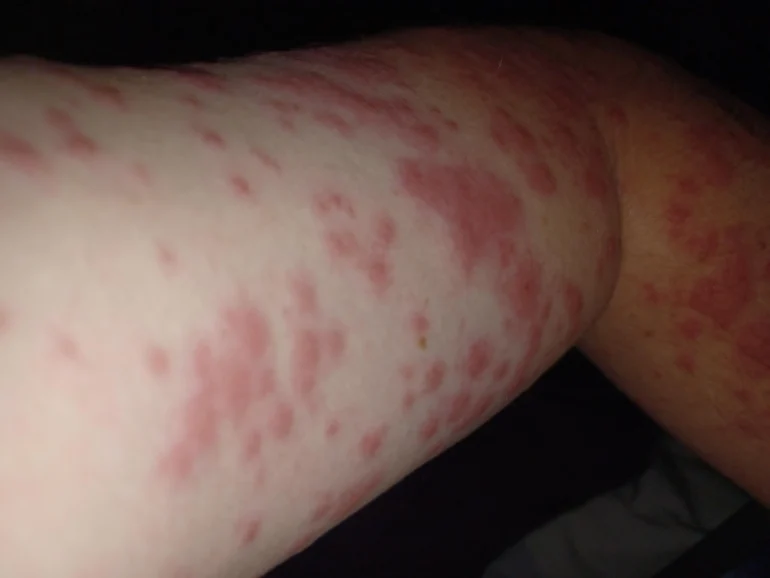 slike alergija na koži 7