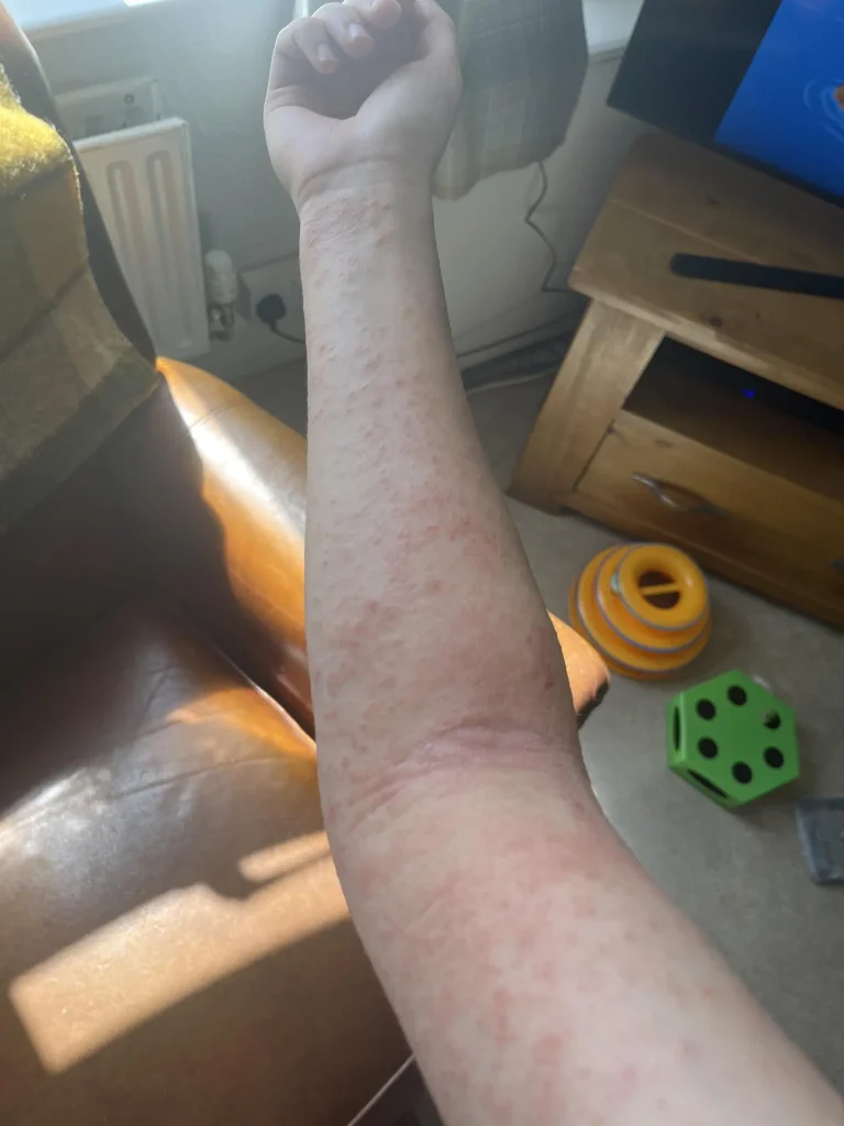 slike alergija na koži 9