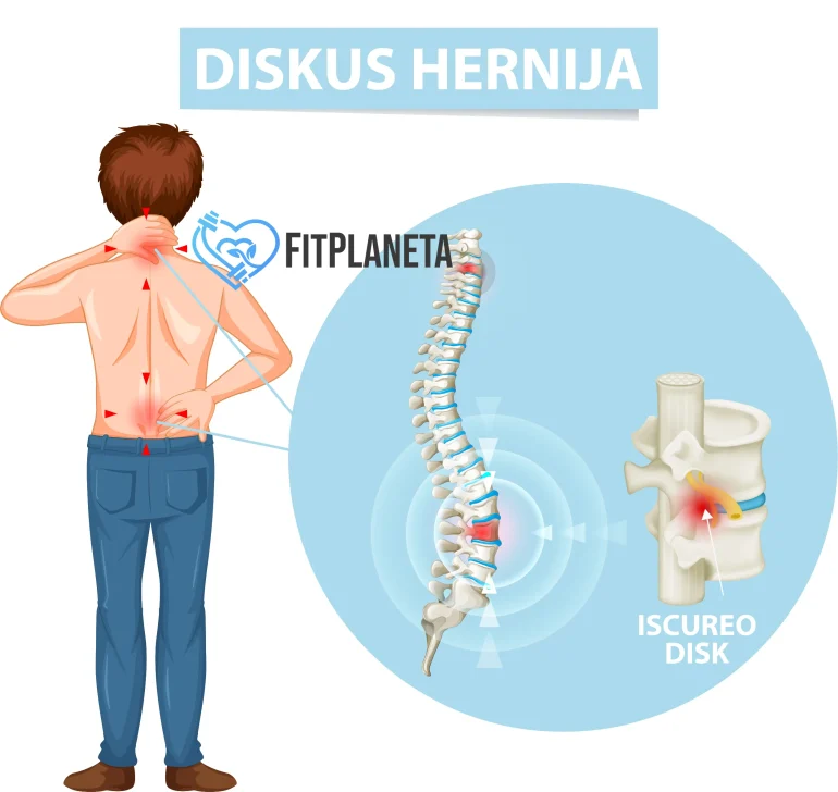 Diskus hernija bol u donjem delu leđa
