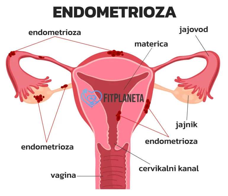 Endometrioza bol u donjem delu stomaka kod žena
