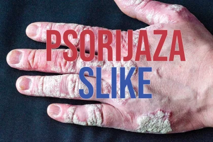 Psorijaza slike