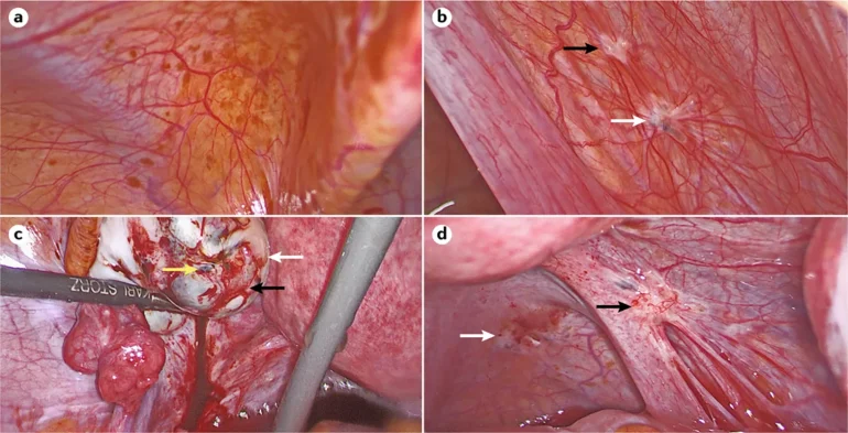 Endometrioza na laparoskopiji