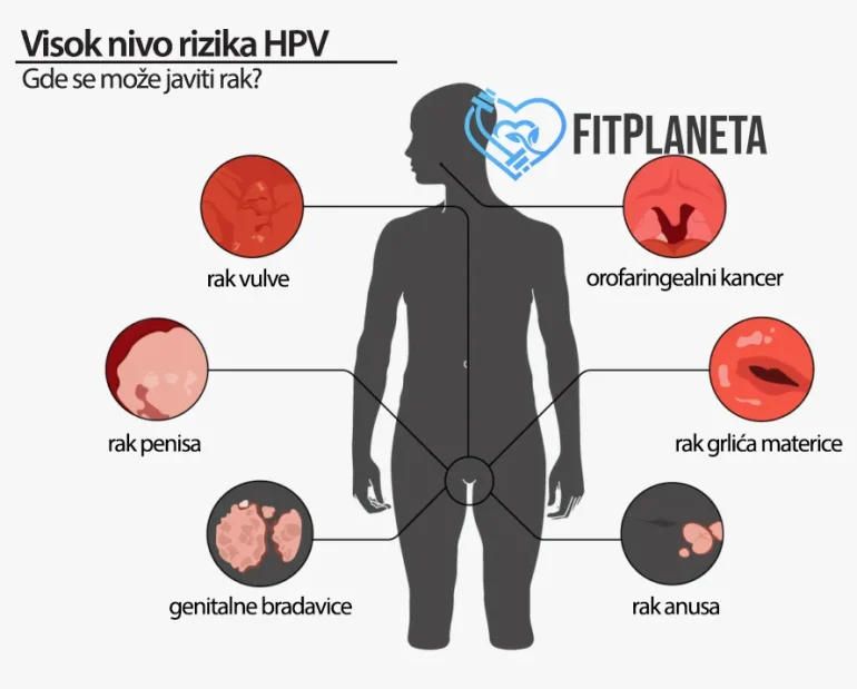 HPV rizik od kancera