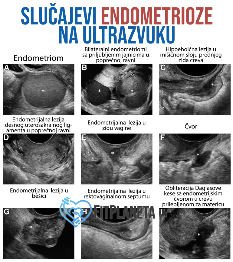 Slučajevi Endometrioze na ultrazvuku