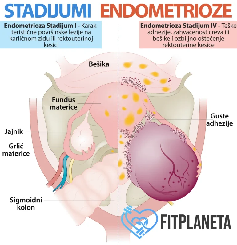 Stadijumi Endometrioze