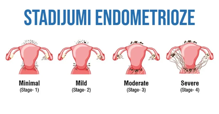 Stadijumi endometrioze