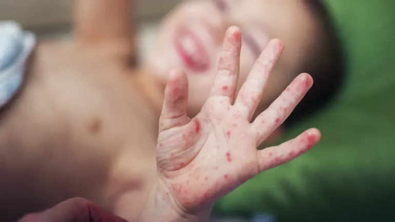 Virusni osip kod dece SLIKE 03 - Bolest ruku, nogu i usta