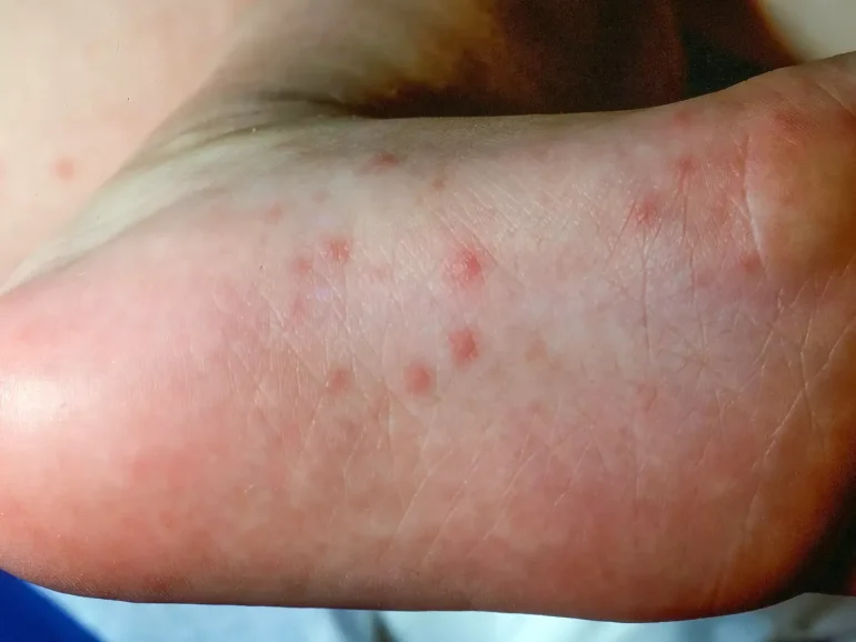 Virusni osip kod dece SLIKE - Bolest ruku, nogu i usta