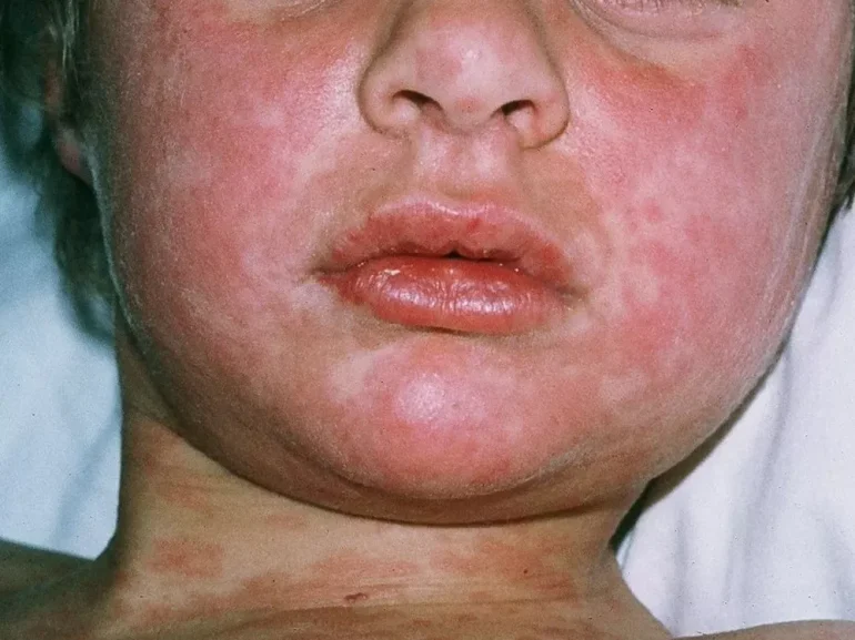 Virusni osip kod dece SLIKE - Male boginje