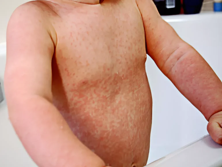 Virusni osip kod dece SLIKE - Rubeola nemačke boginje