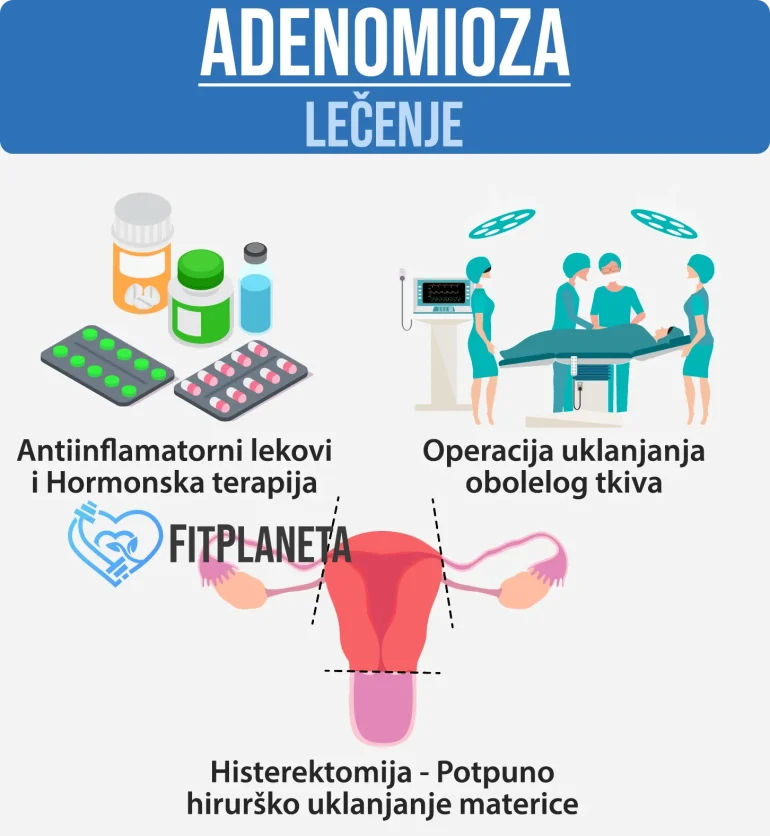 Adenomioza Lečenje