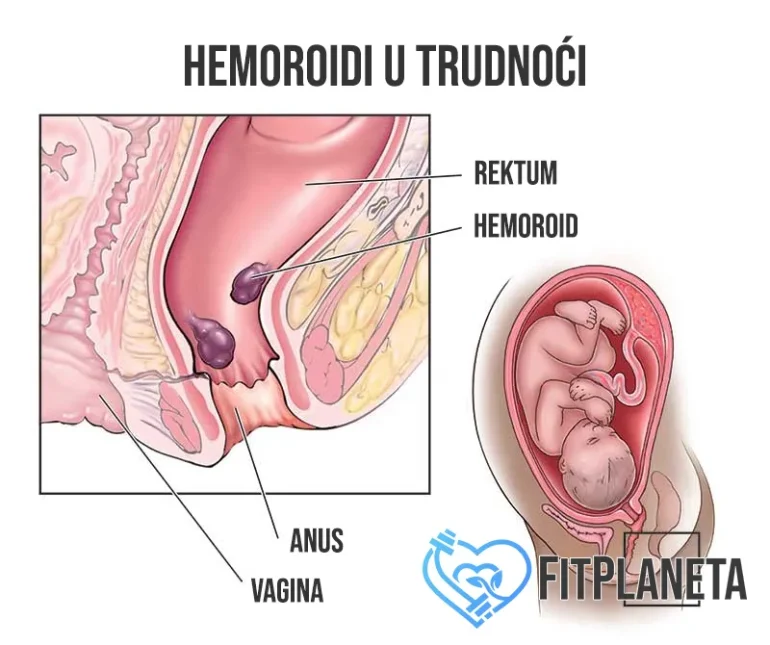 Hemoroidi u trudnoći